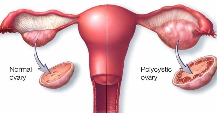 polycystic ovary syndrome treatment in bhubaneswar, odisha